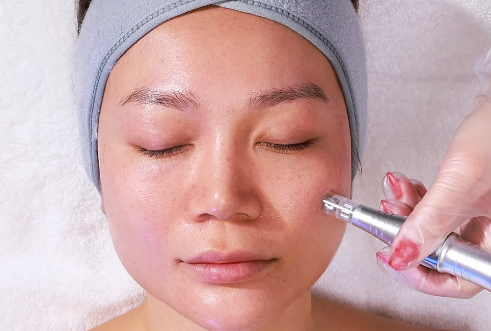 RF Microneedling Treatment and Smooth Skin in Toronto.