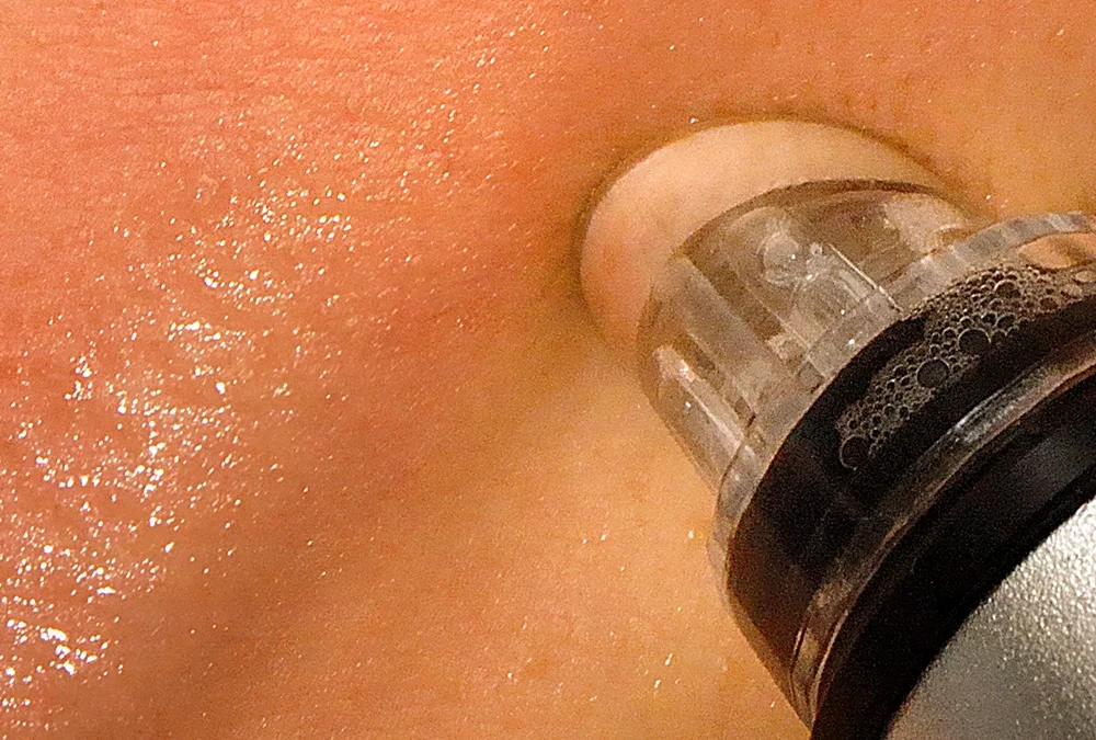 Hydration facial : A Blend of Science and Luxury